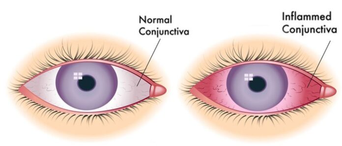 Acute Conjunctivitis