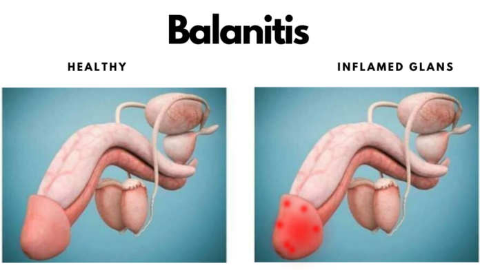 Balanitis