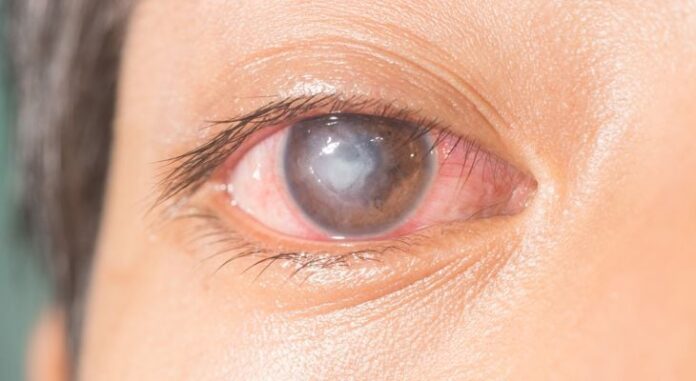 Corneal Ulcer