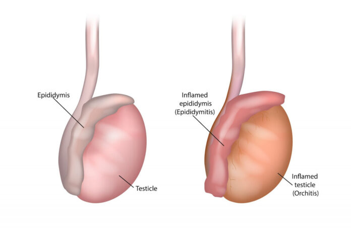 Orchitis