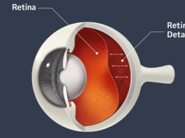 retinal detachment