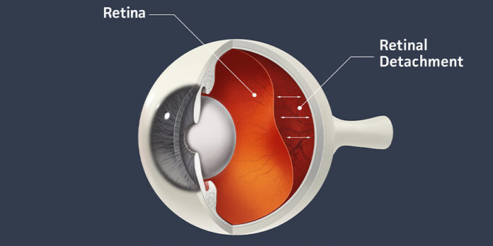 retinal detachment