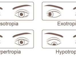 Strabismus