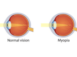 myopia disease