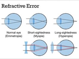 refractive errors